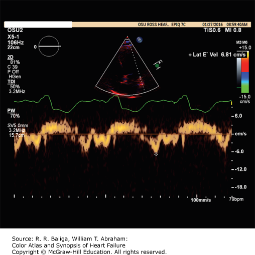 Echocardiography In Congestive Heart Failure | Thoracic Key