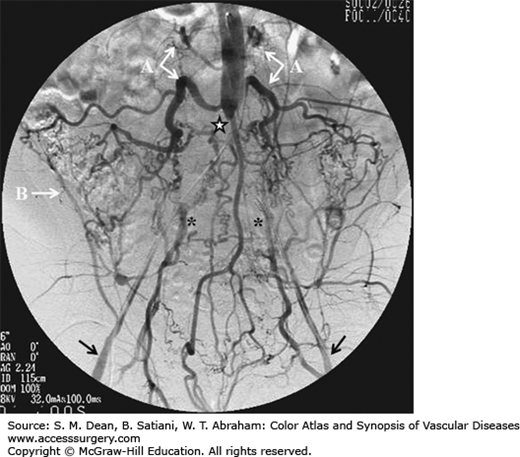 AORTOILIAC DISEASE: OCCLUSION | Thoracic Key