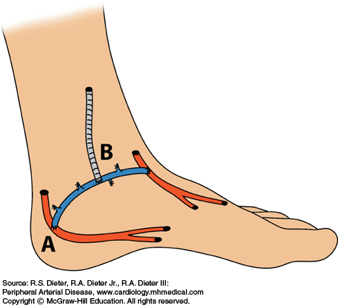 Lower Extremity Revascularization For Atherosclerotic Occlusive Disease ...