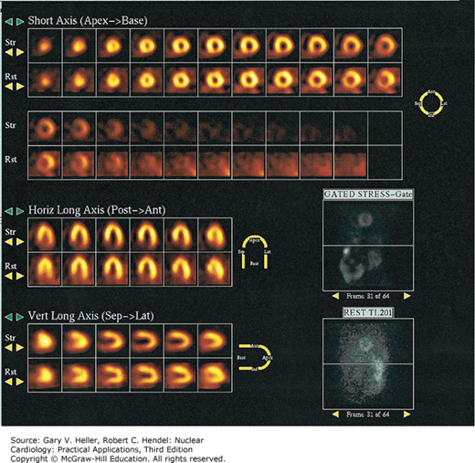 Interpretation And Reporting Of SPECT Myocardial Perfusion Imaging ...