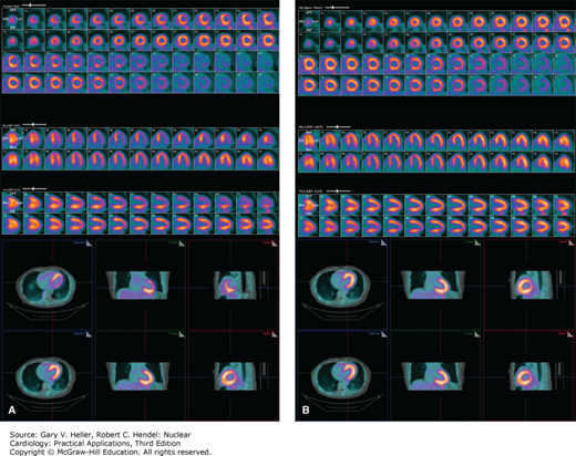 Hybrid Imaging: SPECT–CT And PET–CT | Thoracic Key