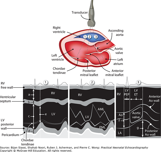 M-Mode Echocardiography And 2D Cardiac Measurements* | Thoracic Key