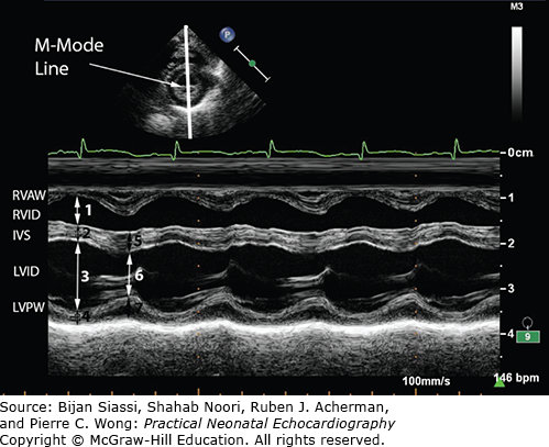 M-Mode Echocardiography And 2D Cardiac Measurements* | Thoracic Key