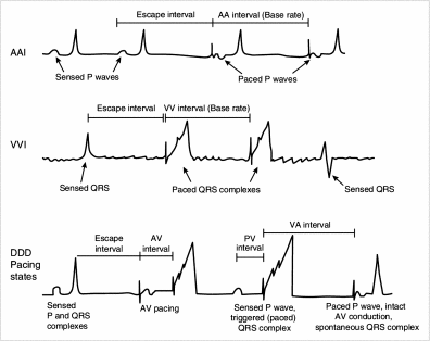 Cardiac Pacing And Pacemaker Rhythms | Thoracic Key