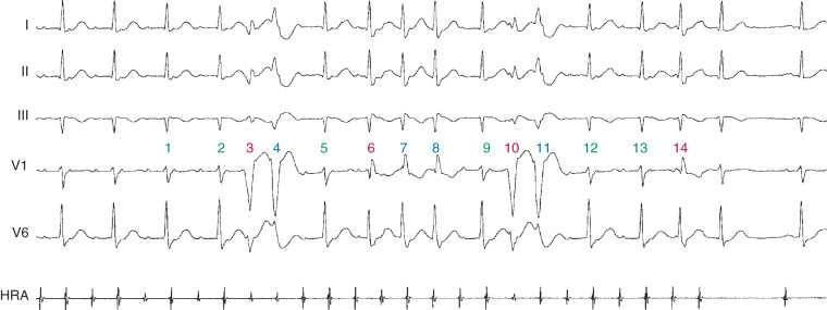 Intraventricular Conduction Abnormalities | Thoracic Key