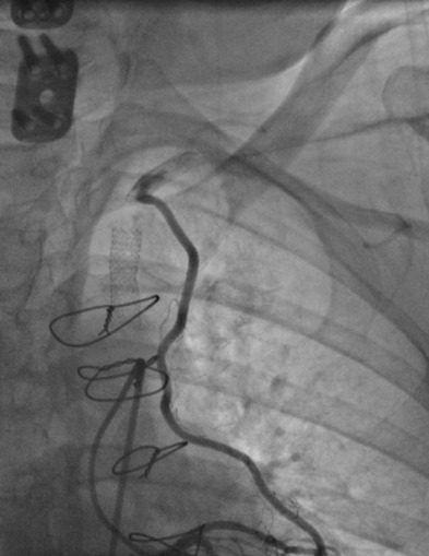 Bypass Graft Interventions | Thoracic Key