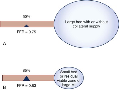 Fractional Flow Reserve | Thoracic Key