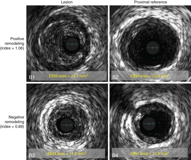 Intravascular Ultrasound Imaging | Thoracic Key