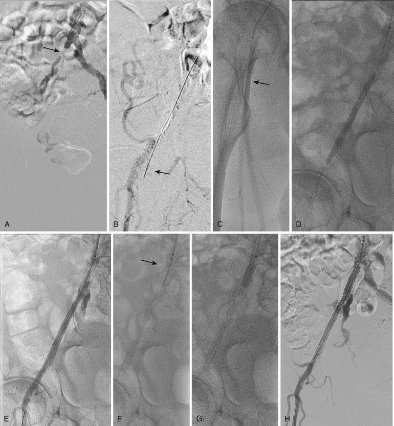 Intervention For Lower Extremity Arterial Disease | Thoracic Key