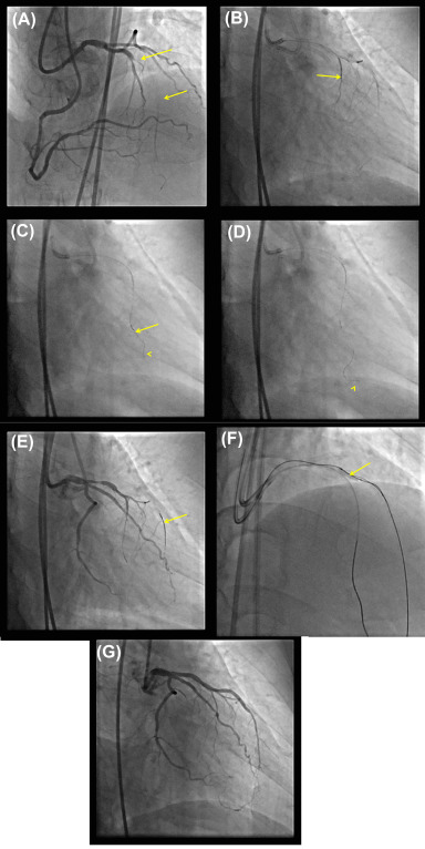 The Retrograde Approach | Thoracic Key