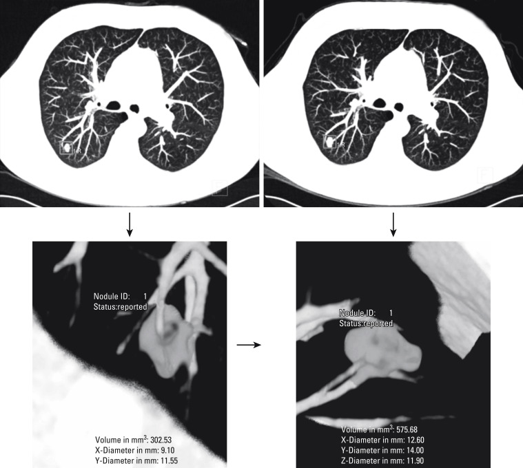 Screening For Lung Cancer | Thoracic Key