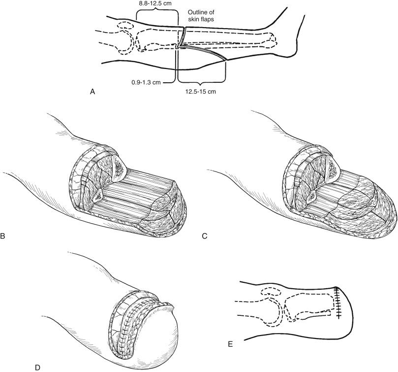 Above- And Below-Knee Amputation | Thoracic Key