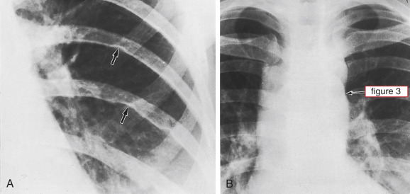 Aortic Coarctation And Interrupted Aortic Arch | Thoracic Key