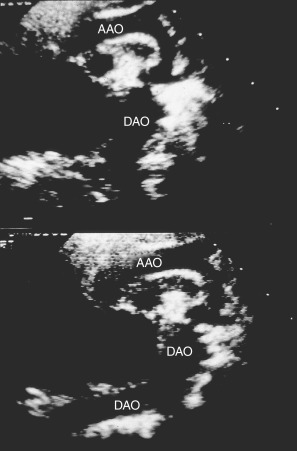 Aortic Coarctation And Interrupted Aortic Arch | Thoracic Key