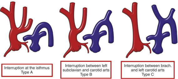 Aortic Coarctation And Interrupted Aortic Arch | Thoracic Key