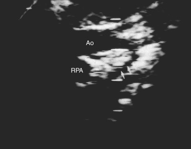 Aortic Coarctation And Interrupted Aortic Arch | Thoracic Key