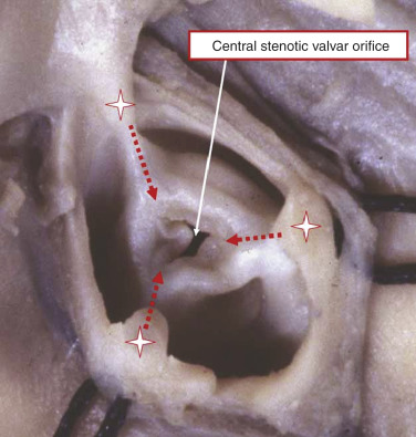 Pulmonary Stenosis | Thoracic Key