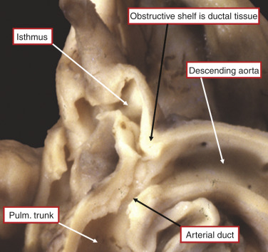 Aortic Coarctation And Interrupted Aortic Arch | Thoracic Key