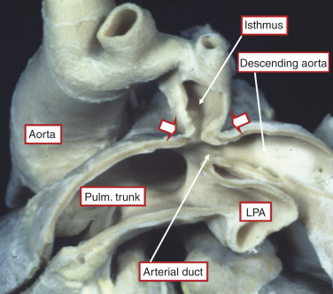 Aortic Coarctation And Interrupted Aortic Arch | Thoracic Key