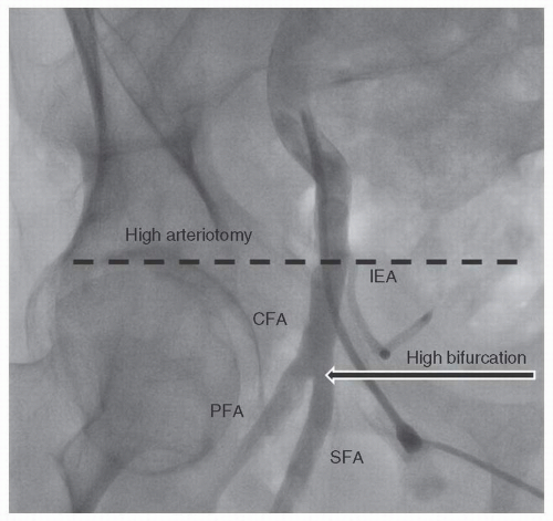 Percutaneous Vascular Access: Transfemoral, Transseptal, Apical, And ...