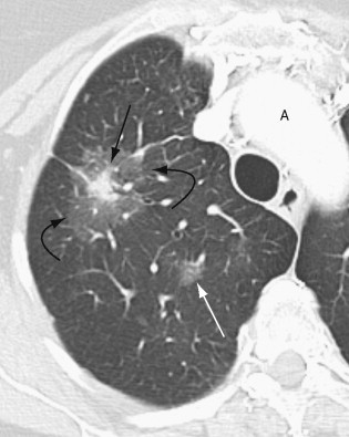 Imaging Tumors Of The Lung And Pleura | Thoracic Key