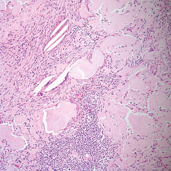 Tumors Of The Pleura | Thoracic Key