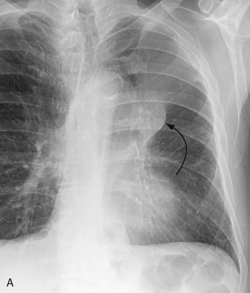 Imaging Tumors Of The Lung And Pleura | Thoracic Key