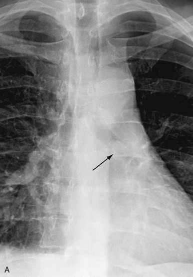 Imaging Tumors Of The Lung And Pleura | Thoracic Key