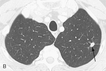 Imaging Tumors Of The Lung And Pleura | Thoracic Key