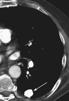 Imaging Tumors Of The Lung And Pleura | Thoracic Key