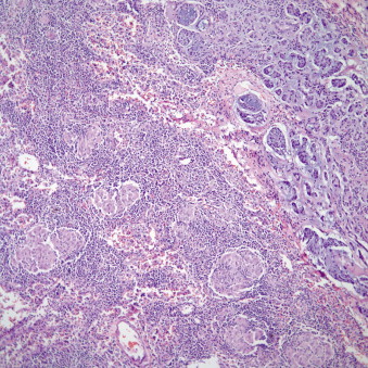 Salivary Gland–Type Tumors Of The Lung | Thoracic Key