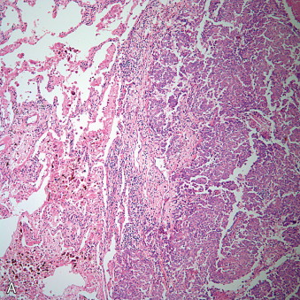 Tumors Of The Pleura | Thoracic Key