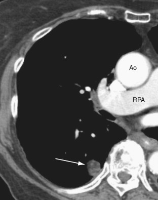 Imaging Tumors Of The Lung And Pleura | Thoracic Key