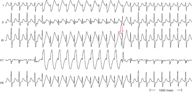 Intraventricular Conduction Abnormalities | Thoracic Key