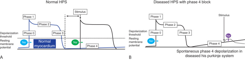 Intraventricular Conduction Abnormalities | Thoracic Key