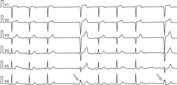 Intraventricular Conduction Abnormalities | Thoracic Key