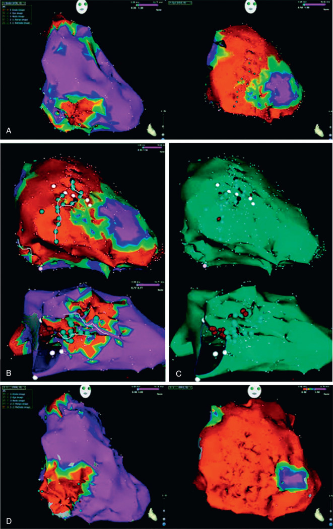 Ventricular Arrhythmias In Adults With Congenital Heart Disease ...