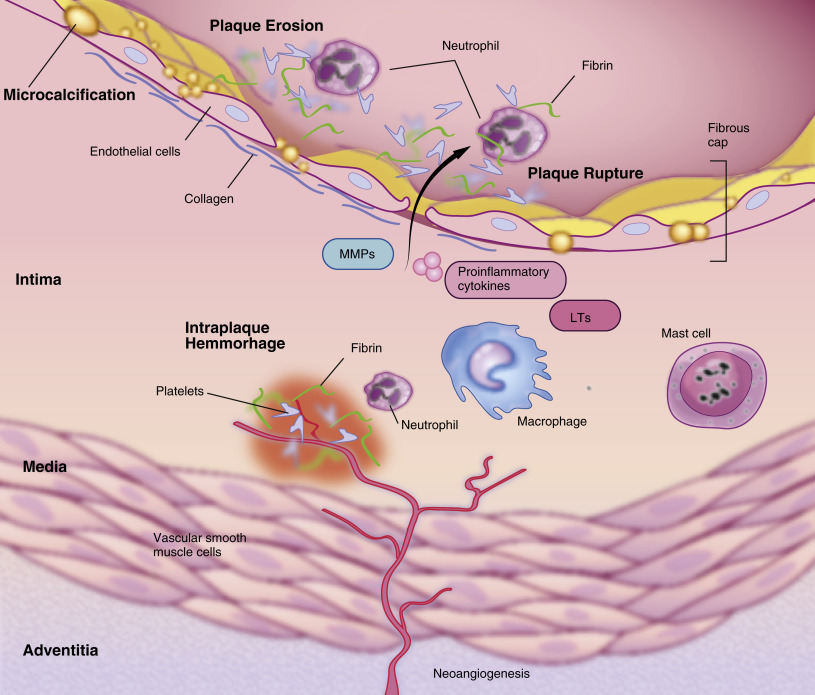 Basic Mechanisms Of Atherosclerosis | Thoracic Key