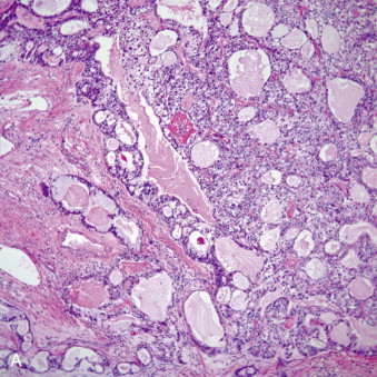 Salivary Gland–Type Tumors Of The Lung | Thoracic Key