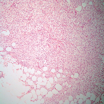 Tumors Of The Pleura | Thoracic Key