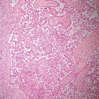 Tumors Of The Pleura | Thoracic Key