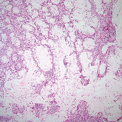 Benign Tumors And Tumor-like Lesions Of The Lung | Thoracic Key