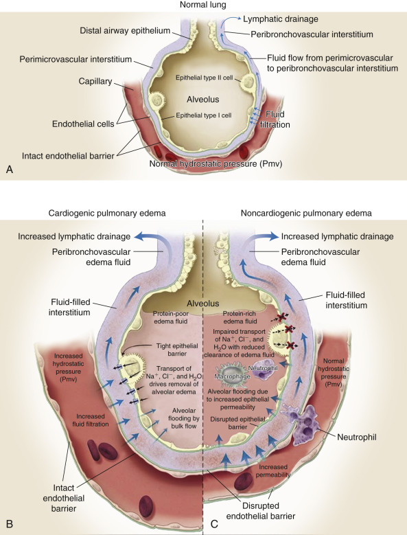 Pulmonary Edema | Thoracic Key