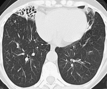 Bronchiectasis | Thoracic Key