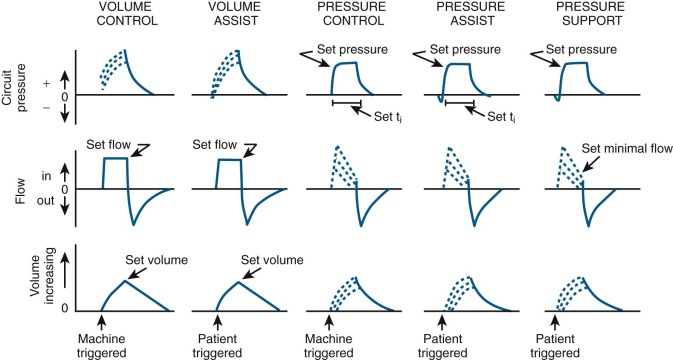 Simplifying Mechanical Ventilation – Part I: Types Of, 54% OFF