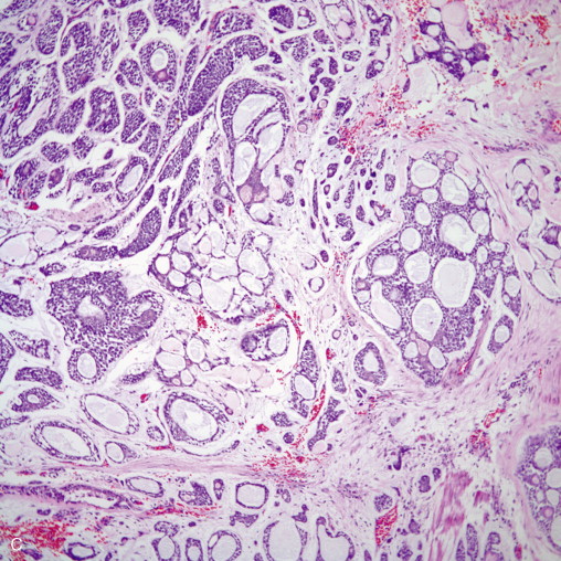 Salivary Gland–Type Tumors Of The Lung | Thoracic Key