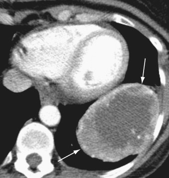 Imaging Tumors Of The Lung And Pleura | Thoracic Key