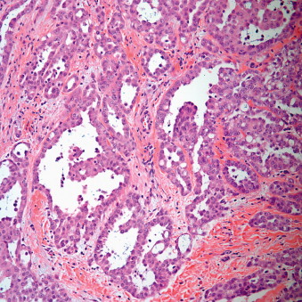 Tumors Of The Pleura | Thoracic Key