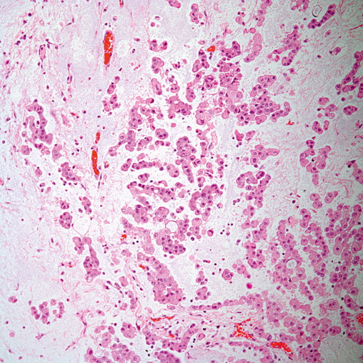 Tumors Of The Pleura | Thoracic Key