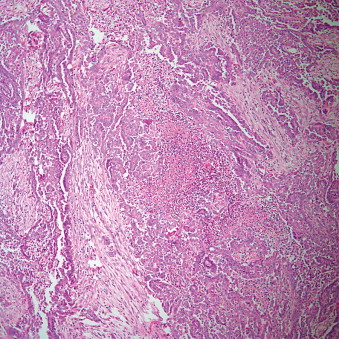 Tumors Of The Pleura | Thoracic Key